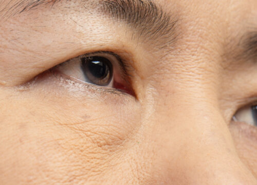 Photo of an older woman's eyes with cataracts