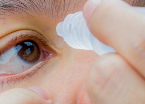 Photo of a woman with dry eyes adding drops to her eye