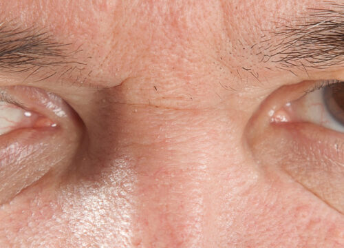 Photo of an older man's eyes with glaucoma