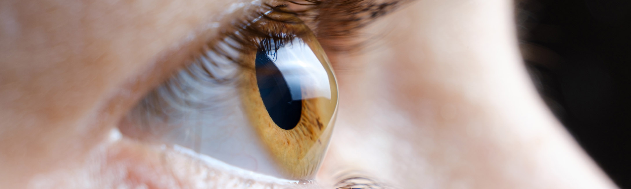 Keratoconus