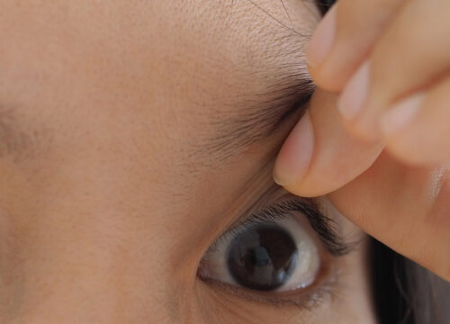 Photo of a woman with an eye issue