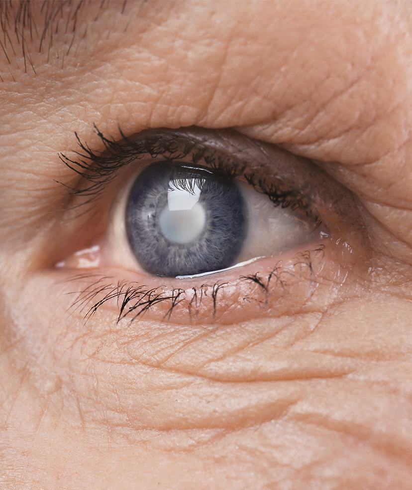 Photo of cataracts in an older woman's eye