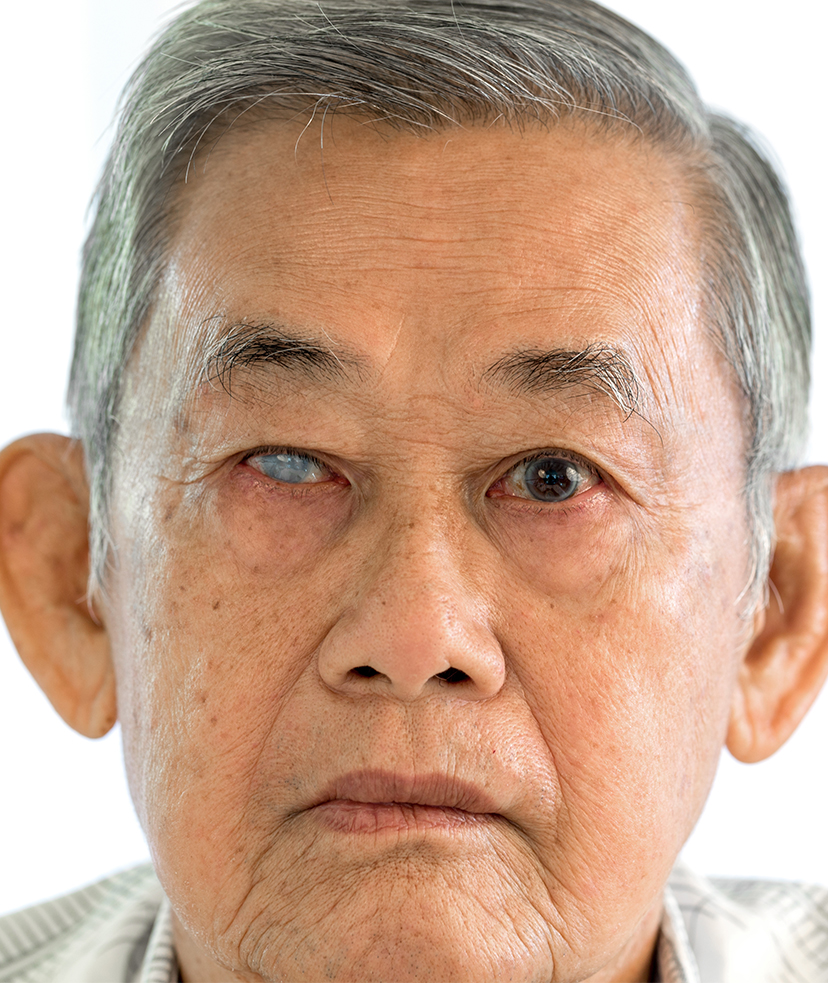 Photo of an older man with glaucoma