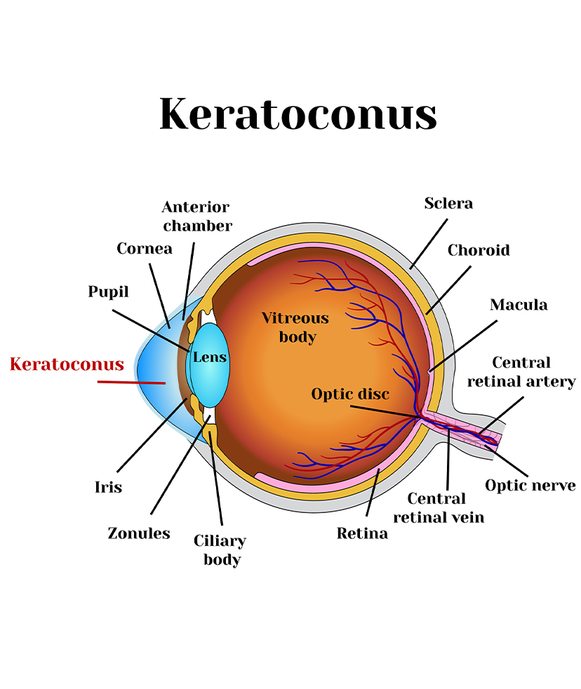 Infographic of keratoconus on an eye