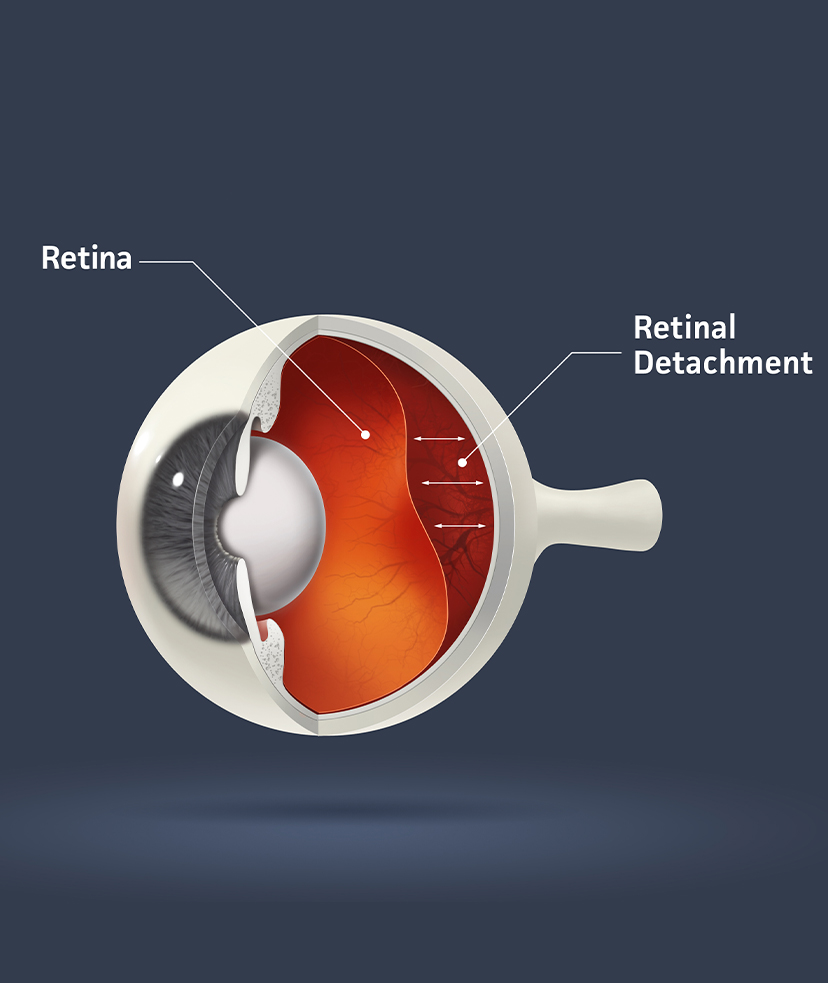 Infographic of a retinal detachment